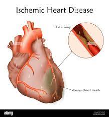 Guérir Naturellement Cardiopathie Ischémique