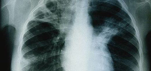 Guérir Naturellement la Tuberculose