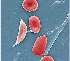 Drépanocytose Soin Naturel