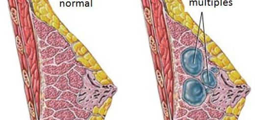 Kystes Mammaires Symptômes Traitement