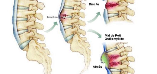 Dysplasie Fibreuse Traitement Naturel
