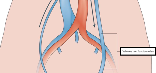 Varicocèle Gauche Remède