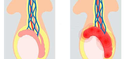 Kyste de l'épididyme Traitement