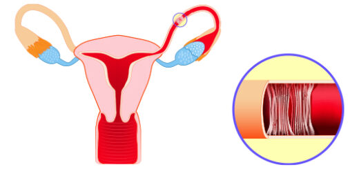 Trompes Bouchées Traitement Naturel