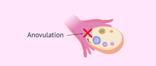 Anovulation Causes Traitements