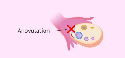 Anovulation Causes Traitements