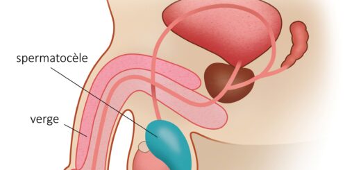Spermatocèle Traitement Naturel